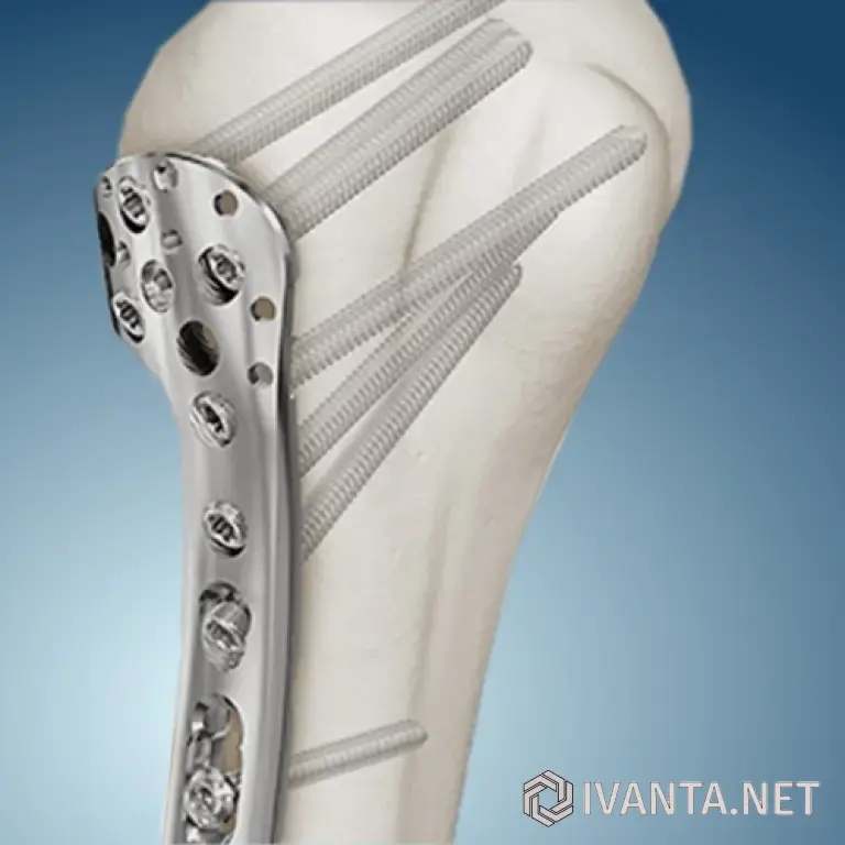 Пластины для накостного остеосинтеза