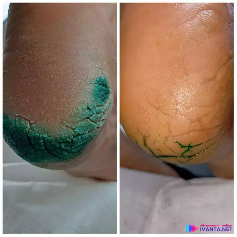 Услуги подолога Воткинск