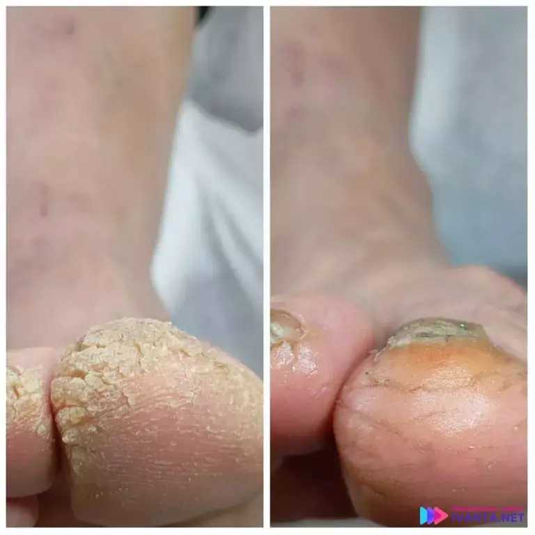 Услуги подолога Воткинск