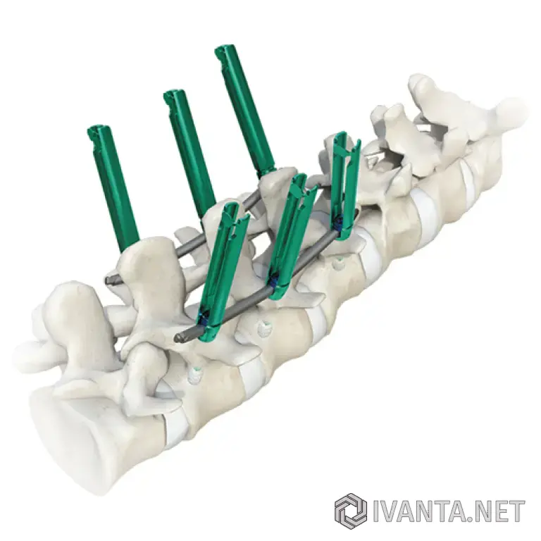 Имплантат MIS Plus